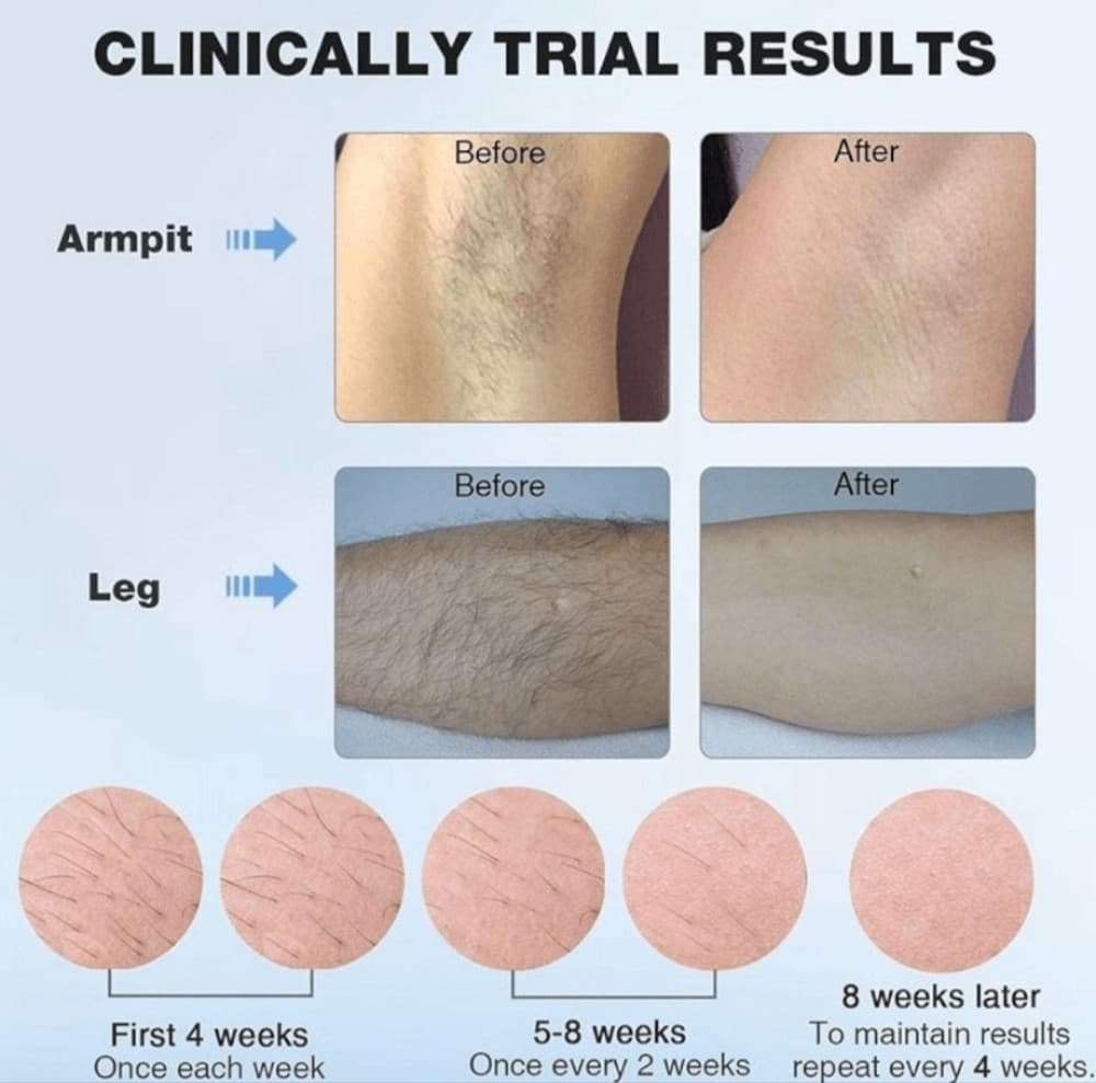 Uređaj za Lasersku Epilaciju sa Ledenim Efektom Epilator Led 4